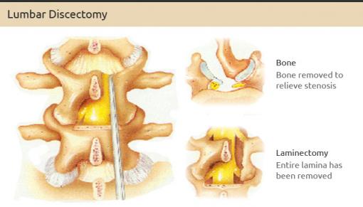 Relief back with Lumbar Discectomy Surgery hospital in India