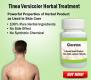 Natural Treatment for Tinea Versicolor