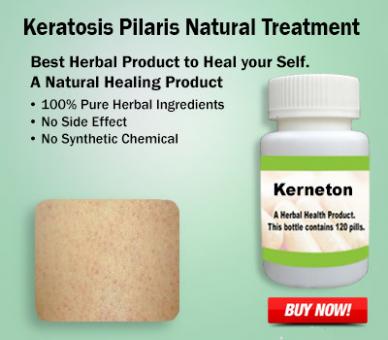 Natural Treatment for Keratosis Pilaris